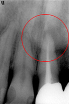 根の先の病気・レントゲン撮影写真