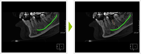 インプラント時のCT写真