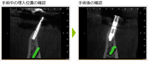 インプラント時のCT写真