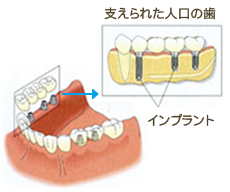 インプラントでの治療法画像