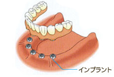 インプラントでの治療法画像